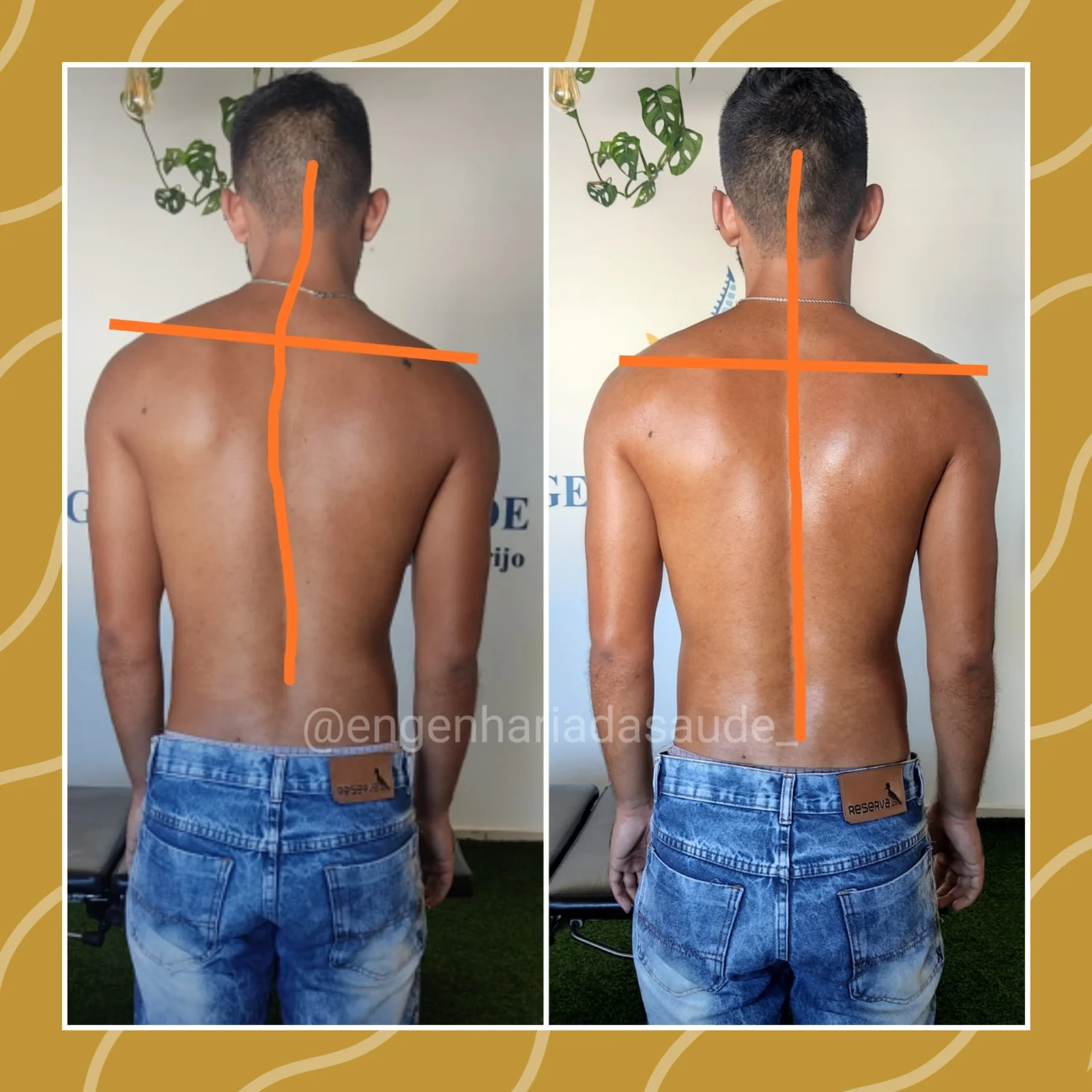 Tratamento de escoliose antes x depois