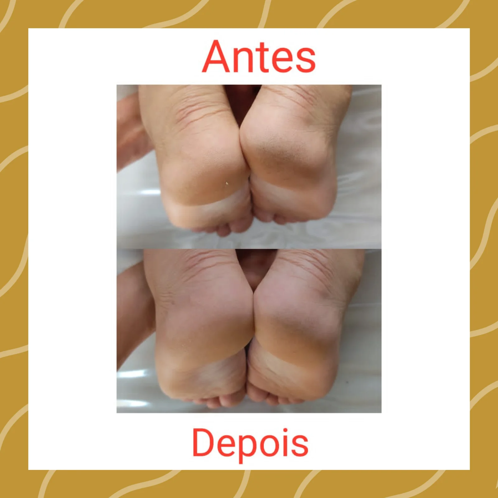 tratamento de perna menor do que a outra